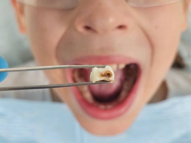 Best Tooth Infection Emergency Dentist  in Villa Park, CA